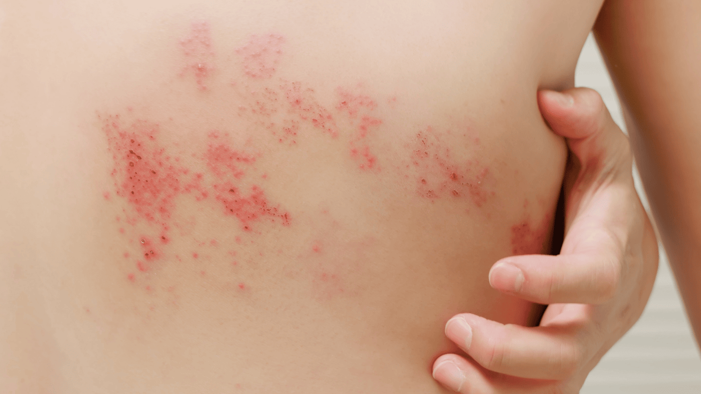 Shingles Treatment_1440x810.png