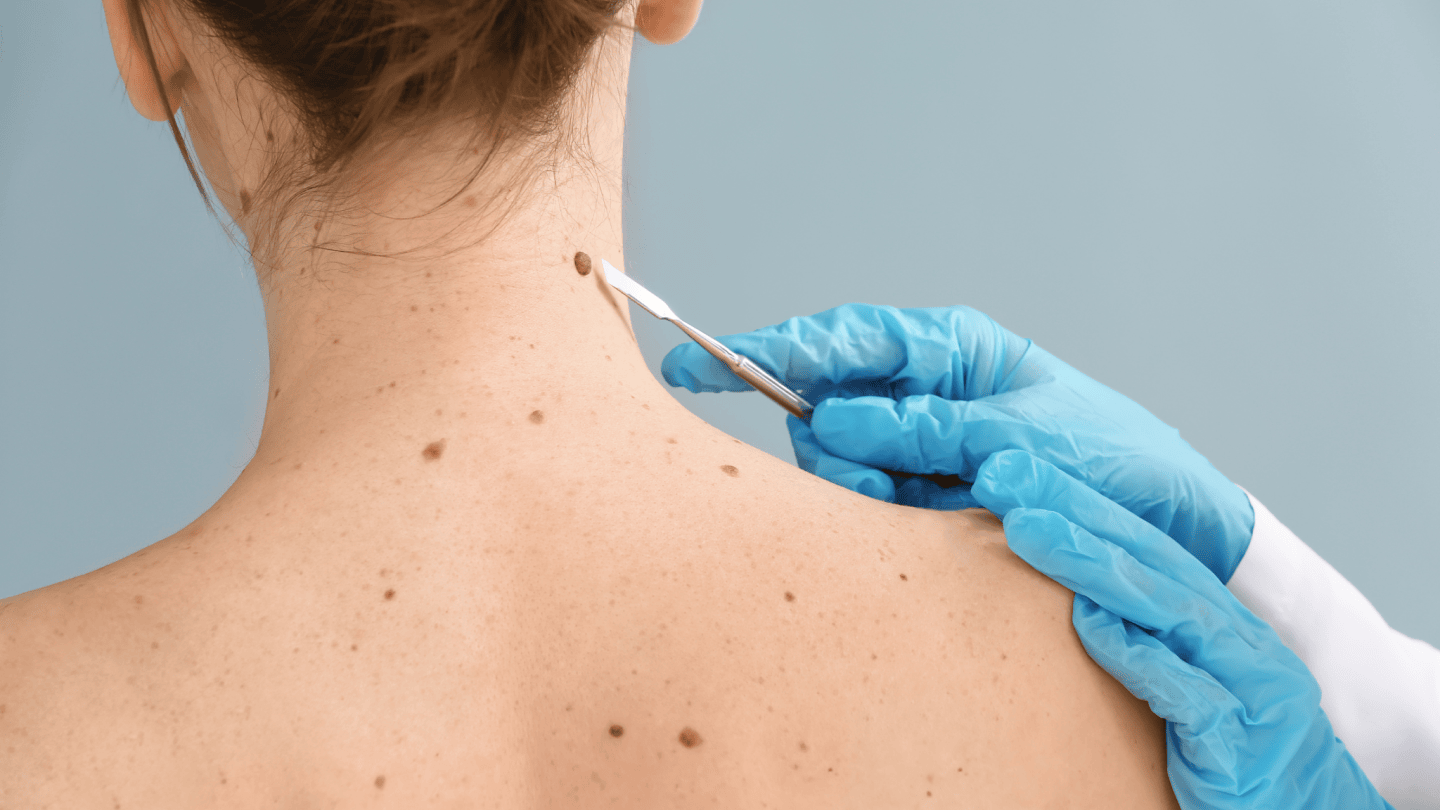 Skin Cancer & Cancerous Mole Screening