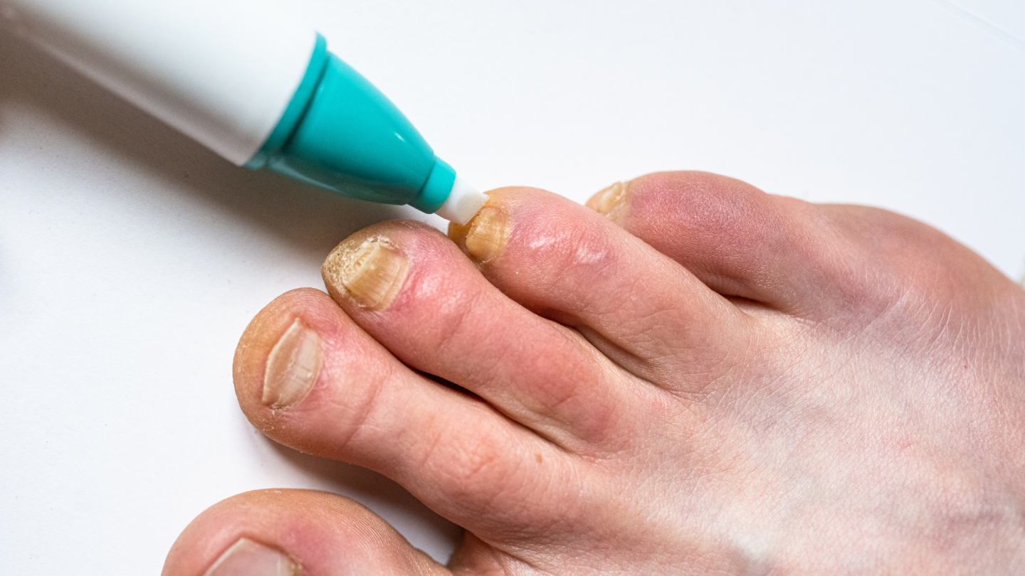 Fungal Infection Treatment_1440x810.png