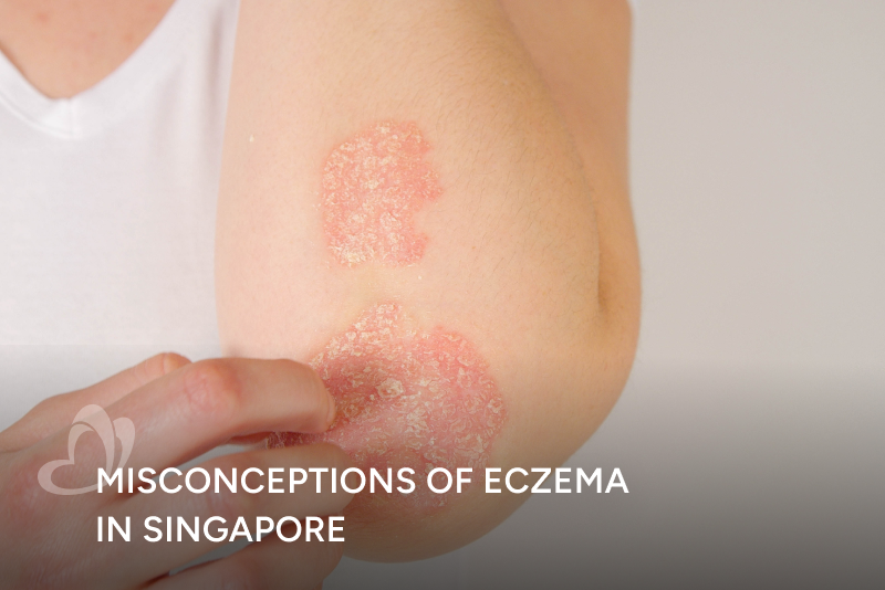 Misconceptions of Eczema in Singapore_Thumbnail_400x267.png