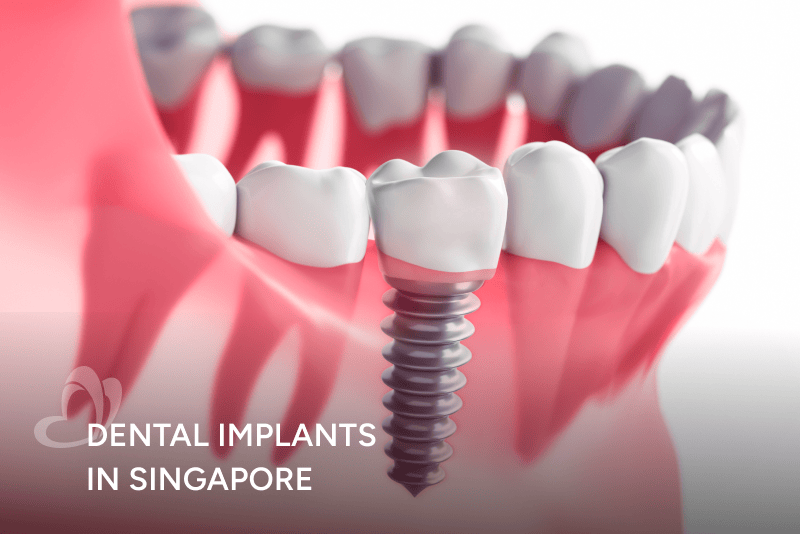 Dental_Implants_Thumbnail_400x267.png