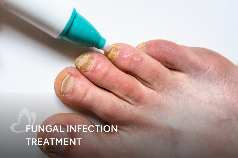 Fungal Infection Treatment_Thumbnail_400x267.png