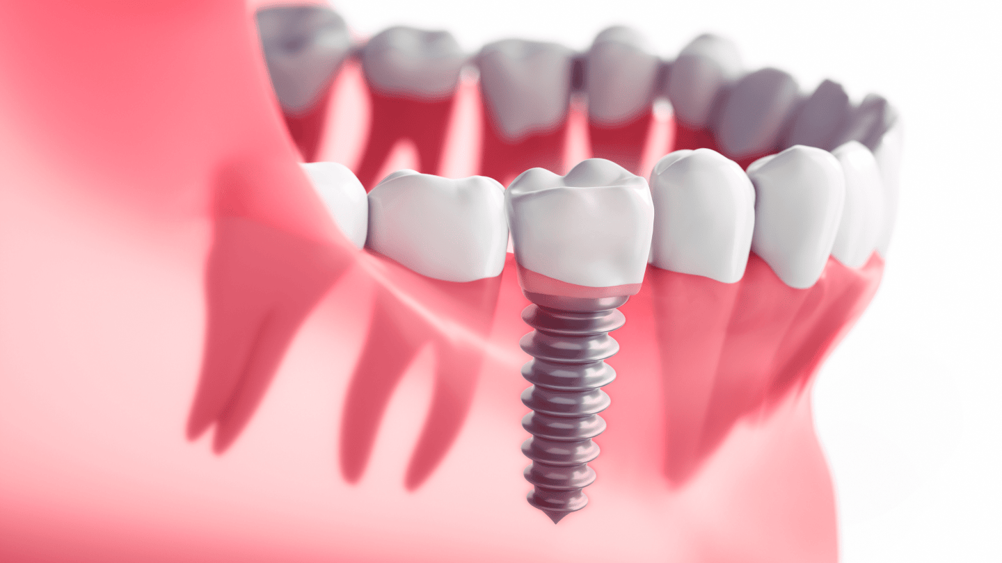 Dental_Implants_1440x810.png