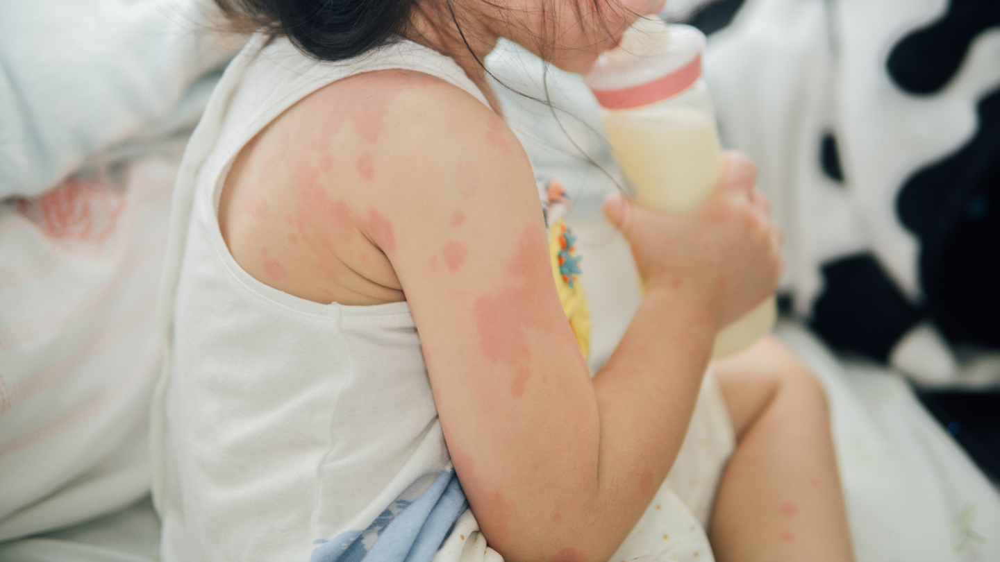 Common Skin Infections in Children_1440x810.png