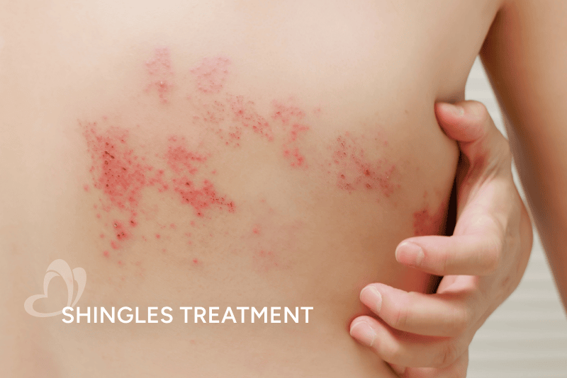 Shingles Treatment_Thumbnail_400x267.png