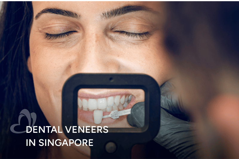 Dental_Veneers_Thumbnail_400x267.png