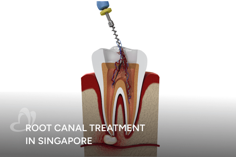 Root_Canal_Treatment_Thumbnail_400x267.png