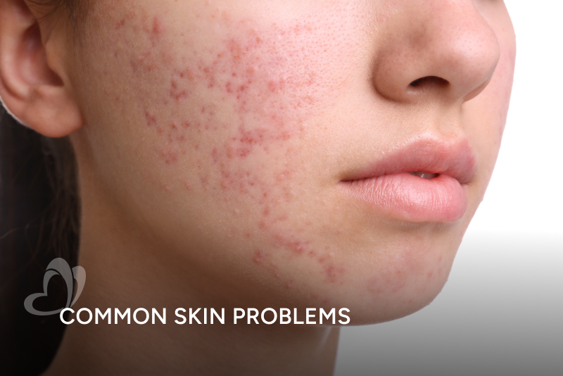 Common Skin Problems_Thumbnail_400x267.png