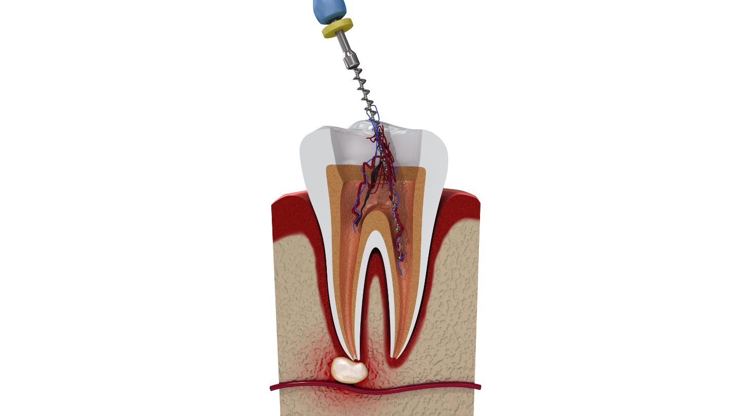 Root_Canal_Treatment_1440x810.png